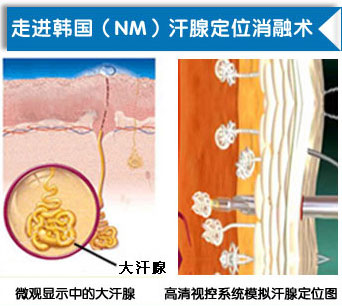 治疗腋臭改良小切口汗腺清除术.jpg