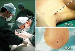 治疗腋臭改良小切口汗腺清除术 手术过程.JPG
